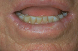 AKs on lower lip (Actinic Cheilitis)