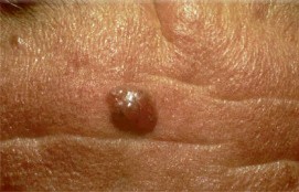 Basal Cell Carcinoma