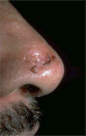 3 Scar-Like (Morpheaform) Basal Cell Carcinoma