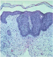 Basal Cell Cancer (superficial variant)