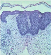 Basal Cell Carcinoma Basal Cell Cancer (superficial variant)