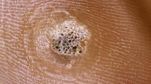 symptoms of these growths symptoms of these growths