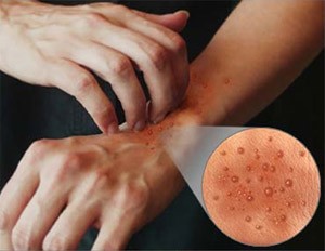Contact Dermatitis – due to an allergen