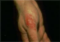 Contact Dermatitis – due to an allergy to Polysporin™ ointment.