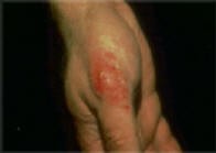 Contact Dermatitis Contact Dermatitis – due to an allergy to Polysporin™ ointment.