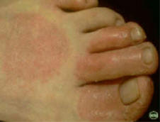 Contact Dermatitis due to shoe leather