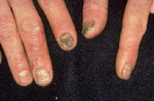 Contact Dermatitis Contact Dermatitis on nails due to acrylates found in nail adhesives
