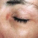 'Tis the season... for eyelid dermatitis