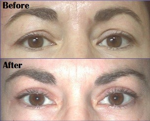 Blepharoplasty (Eyelid Surgery)