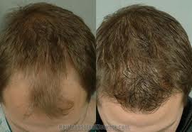 Hair Transplantation Before & After