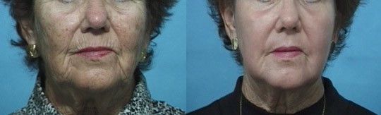 CO2 Laser Resurfacing Results Newnan