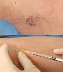 Spider Vein Treatments