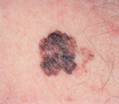 Melanoma Melanoma