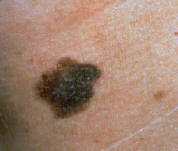 types of melanoma