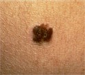TIPS REGARDING MELANOMA TIPS REGARDING MELANOMA