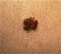 TIPS REGARDING MELANOMA