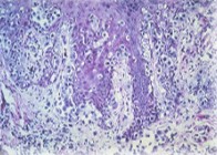 Melanoma – under the microscope