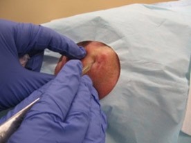 Step 1. Removal of tumor Step 1. Removal of tumor