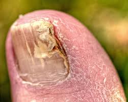 Nail Fungus (Onychomycosis)