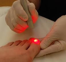 LASER HEAT LASER HEAT