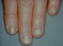 Tetracycline induced nail disease
