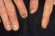 Allergy to nail polish
