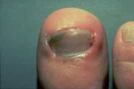 Ingrown Toenail