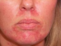 Perioral Dermatitis