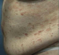 Psoriasis Plaques