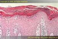 Psoriasis under the microscope Psoriasis under the microscope