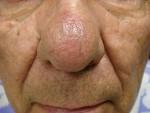Rosacea (Stage I, III) Rosacea (Stage I, III)