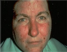 Rosacea (Stage II) Rosacea (Stage II)