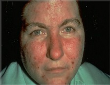 Rosacea (Stage II)