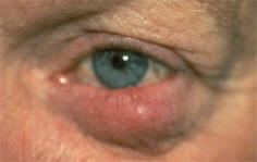 Rosacea ... How can you take the red out?