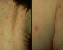Scabies Newnan Skin Infections Peachtree City Intensely