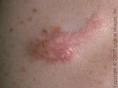 KELOID SCARS