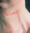 HYPERTROPHIC SCARS
