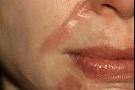 FACIAL SCARS FACIAL SCARS