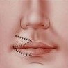 PROCEDURE FOR Z-PLASTY SCAR REVISION PROCEDURE FOR Z-PLASTY SCAR REVISION