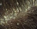 Seborrheic Dermatitis Seborrheic Dermatitis