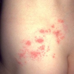 Shingles-occurring in a dermatome 