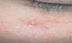 Age Spot & Spider Vein Treatments Age Spot & Spider Vein Treatments