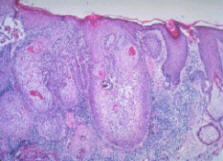 Fig. 4 Squamous Cell Cancer Microscopic view Fig. 4 Squamous Cell Cancer Microscopic view