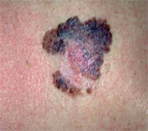 Melanoma the “ABCDE” Rule