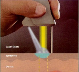 types of treatments for warts types of treatments for warts