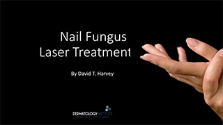 Nail Fungus Laser Treatment