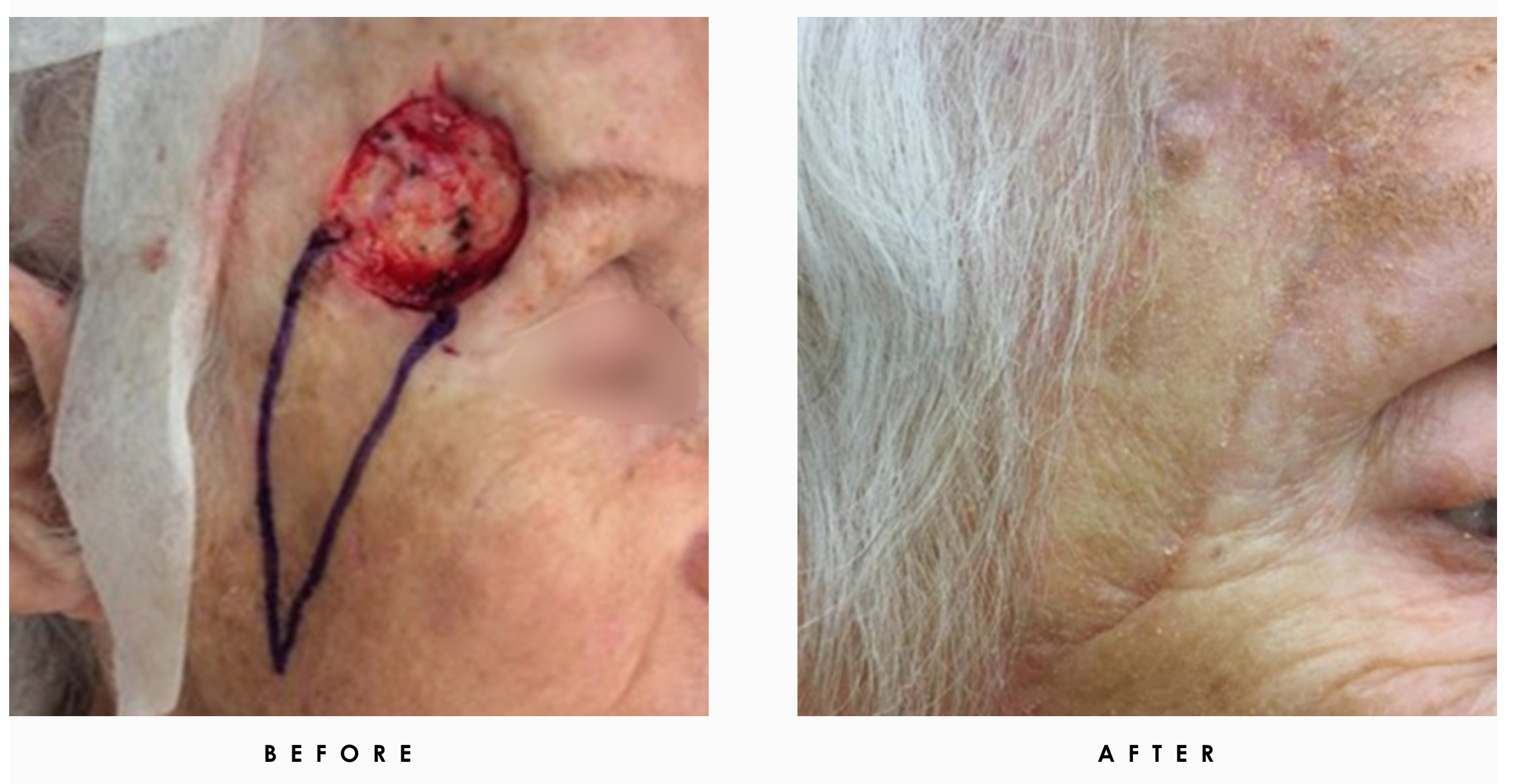 Mohs Surgery before and after