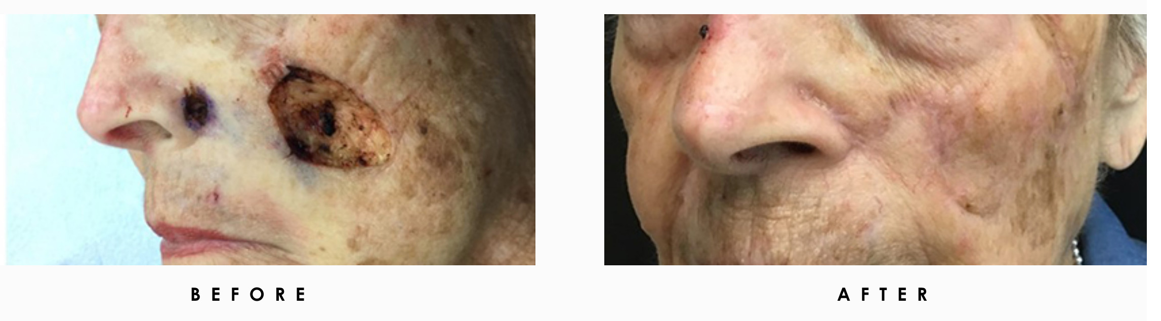 Mohs Surgery before and after