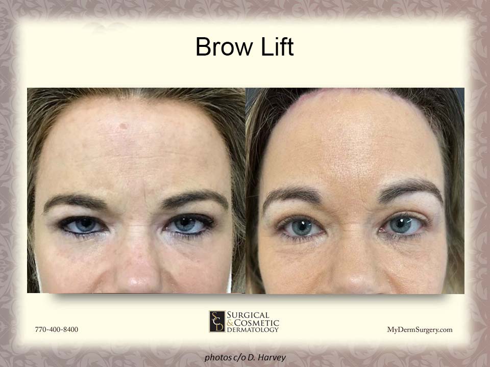 Brow Lift Newnan GA Photo - Dermatology Institute for Skin Cancer and Cosmetic Surgery
