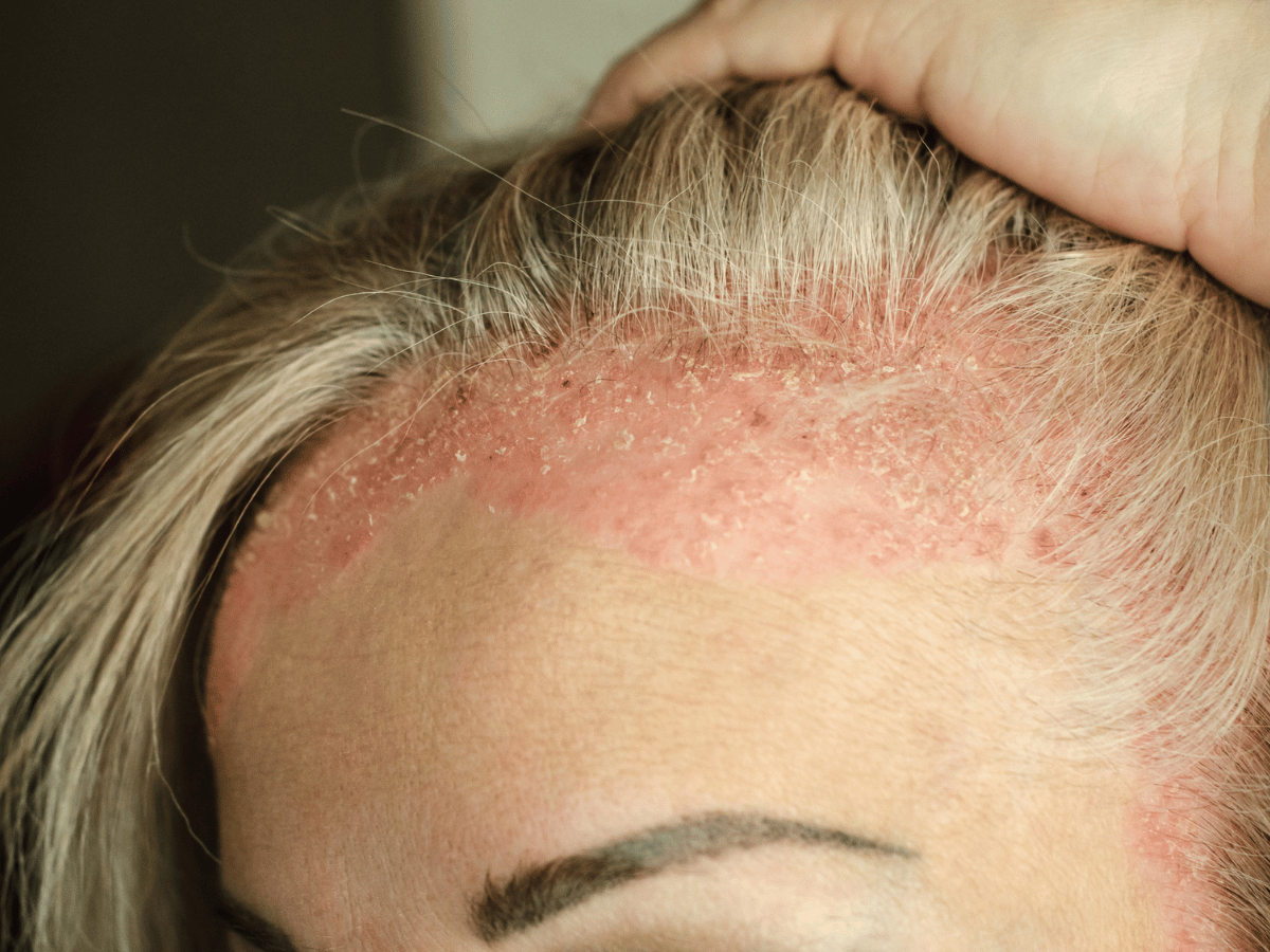 hairline with psoriasis